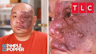 This Man’s Birthmark Is Destroying His Life  Dr Pimple Popper  TLC [upl. by Lovash]