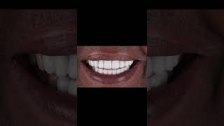 7 Implants 3 Extractions Bone Grafting Full Mouth Restoration Transformation [upl. by Normy]