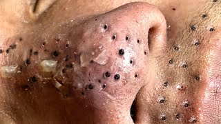 Blackhead Removal With Sac Dep Spa 1000530 [upl. by Kwan757]