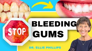 How To QUICKLY Treat Gingivitis and Bleeding Gums [upl. by Etolas499]