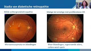 Oogproblematiek bij diabetes webinar [upl. by Nuahsar]