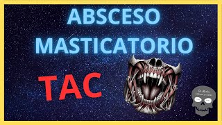 ABSCESO MASTICATORIO 🤐 Hallazgos Radiológicos [upl. by Atinreb]