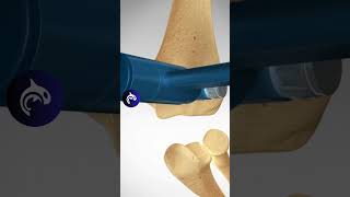 How does an Elbow Replacement work 3D Animation [upl. by Blanchette]