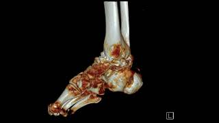 Ankle severe osteoarthritis [upl. by Hezekiah]