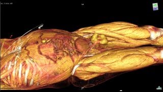 Whole Body CT scan with contrast media [upl. by Nagear]