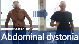 Abdominal wall dystonia  Truncal dystonia  Belly dancer’s dyskinesia  전신 사경증  근긴장이상증 [upl. by Jasper631]