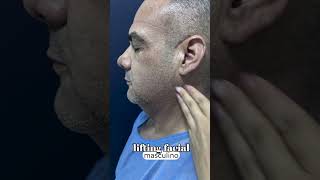 Lifting facial en hombres  Rejuvenecimiento facial cirugiaplastica belleza [upl. by Lenaj]