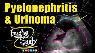 Pyelonephritis with Urinoma  Ultrasound  Case 234 [upl. by Emmalynn]