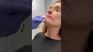 Botox for platysmal bands in the neck [upl. by Donna]