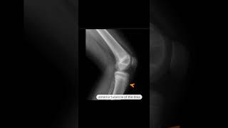 OsgoodSchlatter disease [upl. by Astrid45]