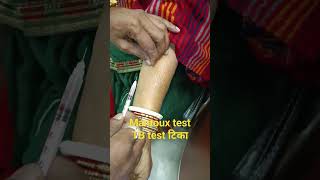 Mantoux test TB ka test skin test shorts short video [upl. by Kepner]