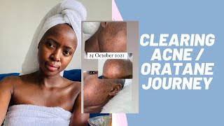 Clearing My AcneDark Spots amp Oratane Journey  Side Effects  South African YouTuber  vlogmas [upl. by Ylrebmek460]