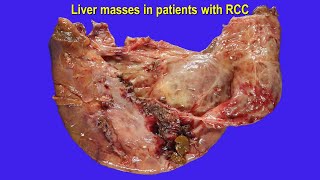 Metastatic renal cell carcinoma RCC or other hepatic tumors [upl. by Cissie]