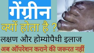 GANGRENE  DIABETIC FOOT  LEG PAIN  Peripheral angioplasty  Dr Gaurav Gangwani [upl. by Yt]