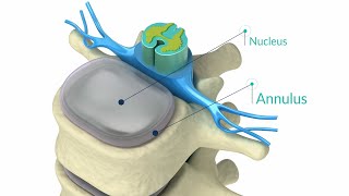 How To Heal A Painful Annular Tear  The Spine Pro [upl. by Afinom]