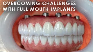 Overcoming Challenges with Full Mouth Implants [upl. by Rodger529]