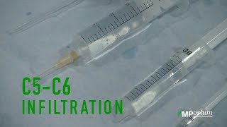 C5C6 infiltration [upl. by Hailat]