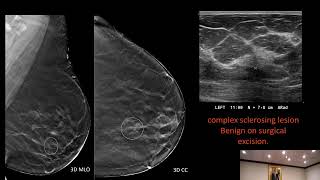 Nonmass findings on Breast Ultrasound Definitions discussions classifications and etiologies [upl. by Eelrebmyk]