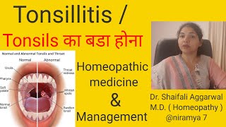 Tonsils Tonsillitis Tonsils का बडा होना Homeopathic Treatment for Tonsils with its Management [upl. by Aicats]