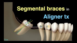 Using segmental braces to close large spaces in aligner treatment｜【Chris Chang Ortho】CC720 [upl. by Habas]