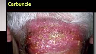 Bacterial Infections of the Skin [upl. by Laurel]