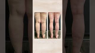 Lipedema Liposuction Before amp After  Salameh Plastic Surgery Center [upl. by Ennej154]