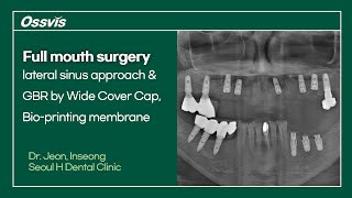 Clinical Case Full mouth surgery lateral sinus approach amp GBR [upl. by Adnohr]