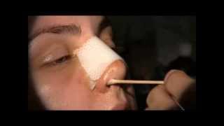 Cleaning your nose after Rhinoplasty [upl. by Azrim]