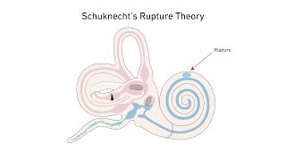 Menieres Disease A New Theory [upl. by Ael842]