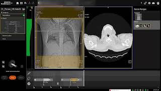 HRCT Chest with filming [upl. by Sluiter]