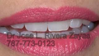 Estetica DentalProstodoncistaImplantes Dentales en Puerto Rico7877730123 [upl. by Latini]