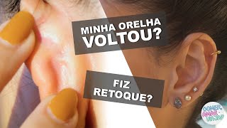 Otoplastia  Cirurgia orelha de abano Minha orelha voltou Precisei de retoque 138  CAV [upl. by Rossner684]