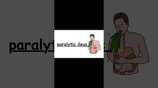 paralytic ileus zerotofinals nursing medical mbbs neet nursingexam bscnursing gnm aiims [upl. by Galateah141]