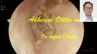 Adhesive Otitis Media [upl. by Hodosh]