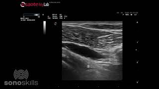 Subcoracoid bursitis during active external internal rotation [upl. by Carry632]