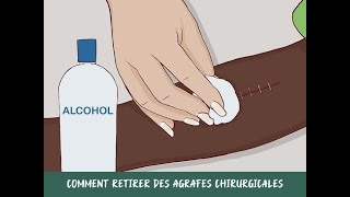 Comment retirer des agrafes chirurgicales [upl. by Mullac]