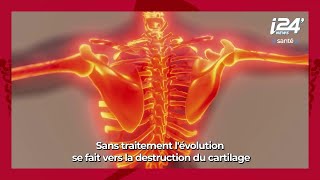 LA MINUTE SANTE  La polyarthrite rhumatoïde origines symptômes et traitements [upl. by Nomrah]