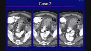 Acute Abdomen Imaging Emergency Radiology [upl. by Lamrert]