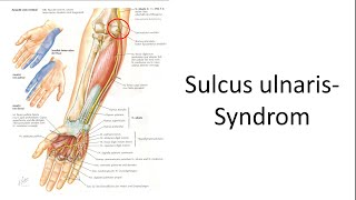 Sulcus ulnaris Syndrom [upl. by Ayotas781]