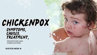 Understanding Chickenpox Symptoms Causes Treatment and Prevention [upl. by Armond789]