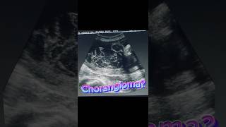 Placenta Mass  Chorangioma  Normal Fetal Scan  Anomaly Ultrasound [upl. by Ahsiekyt]