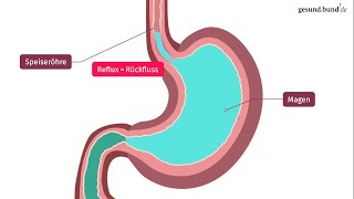 Was ist die Refluxkrankheit [upl. by Breana]