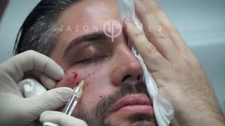 Belotero Fillers For Under Eye Hollows Dark Circles And Eye Bags  Dark Circle Treatment Live [upl. by Weissman]