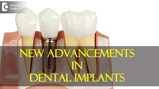 New advancements in dental implants  Dr Girish Rao [upl. by Cherian538]