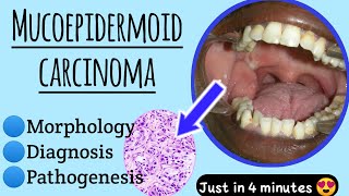 Mucoepidermoid CarcinomaWhat causes Mucoepidermoid carcinomapathology medico [upl. by Picco]