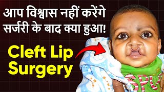 कटे होंठ कटे तालु का निःशुल्क इलाज  Cleft Lip and Palate Surgery at Saraswat Hospital Agra India [upl. by Eal231]