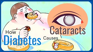 Mechanism of Diabetic Cataract biochemistry [upl. by Asirrak225]