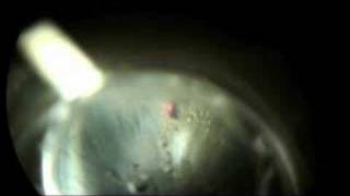 Laser Peripheral Iriditotomy to Prevent Glaucoma Part 2 [upl. by Aneehta]