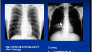 Chest xray interpretation  Lung consolidation and main causes [upl. by Anirroc372]