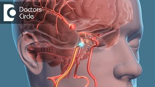 What is the recovery time for Brain Aneurysm  Dr Tejus MN Rao [upl. by Areval]